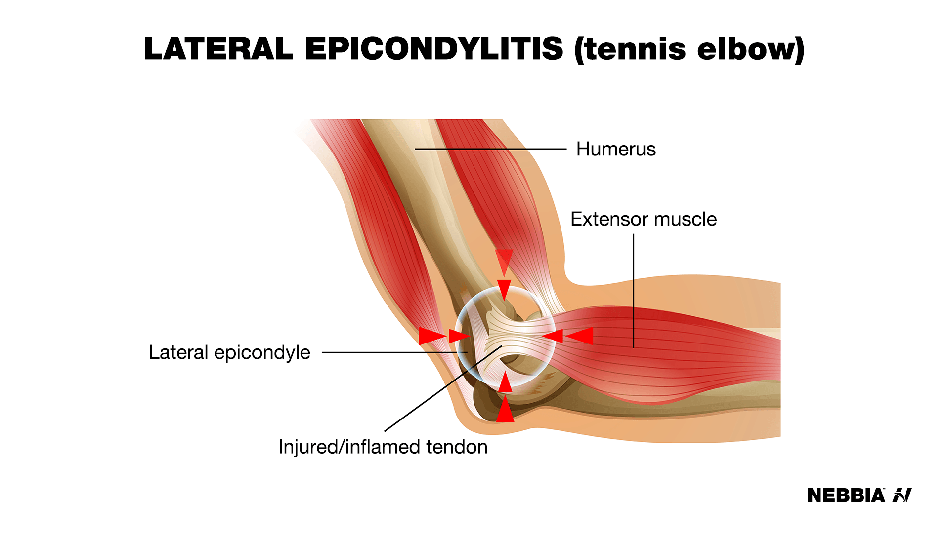 tennis elbow